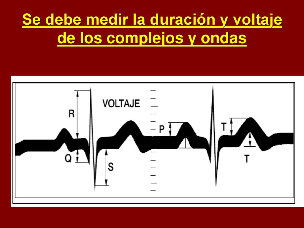 Se debe medir la duración y voltaje de los complejos y ondas