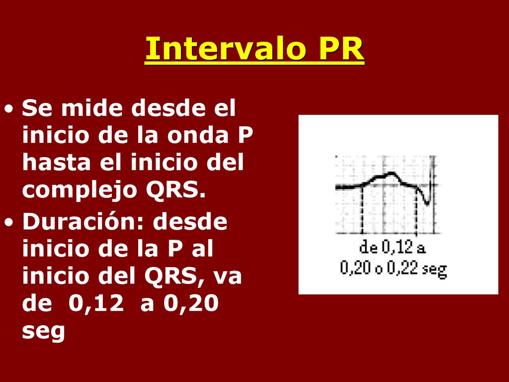 Intervalo PR Se mide desde el inicio de la onda P hasta el inicio del complejo QRS.
