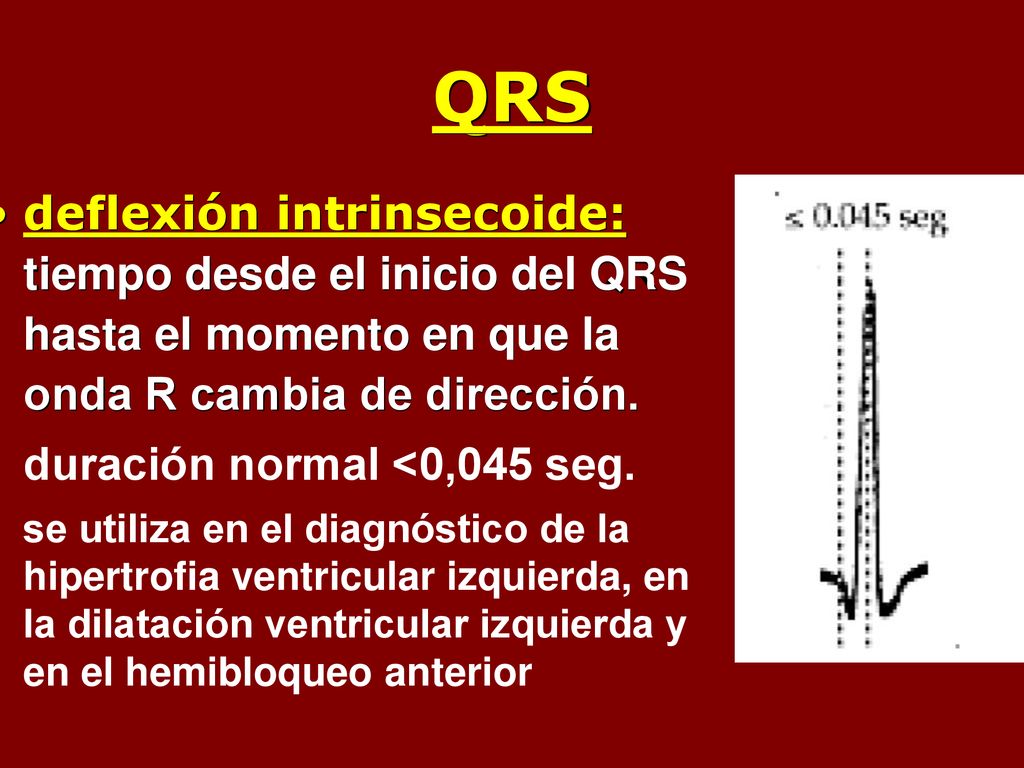 QRS deflexión intrinsecoide: tiempo desde el inicio del QRS hasta el momento en que la onda R cambia de dirección.
