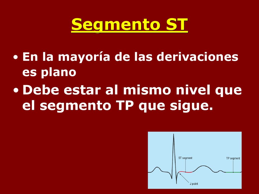 Segmento ST Debe estar al mismo nivel que el segmento TP que sigue.