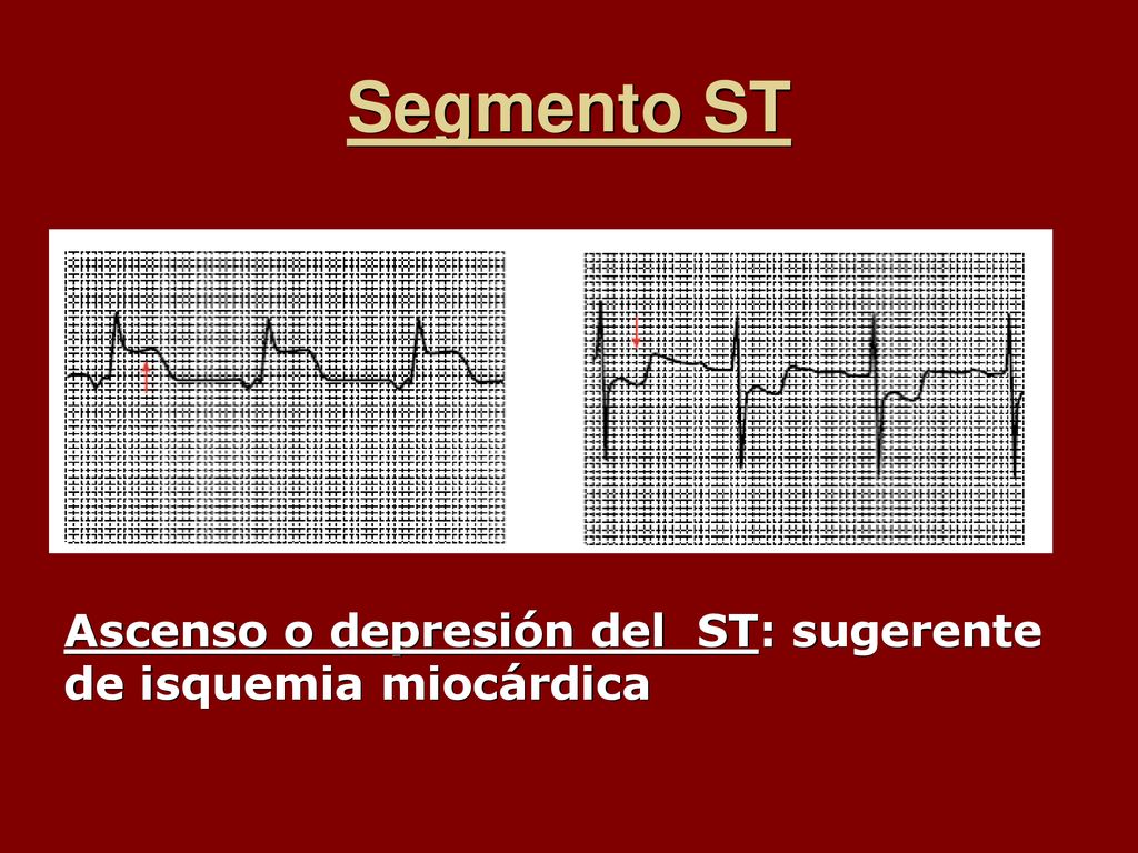 Segmento ST Ascenso o depresión del ST: sugerente de isquemia miocárdica