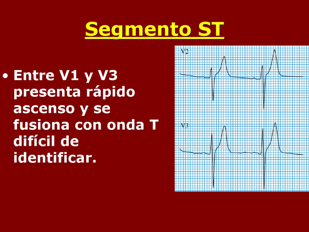 Segmento ST Entre V1 y V3 presenta rápido ascenso y se fusiona con onda T difícil de identificar.