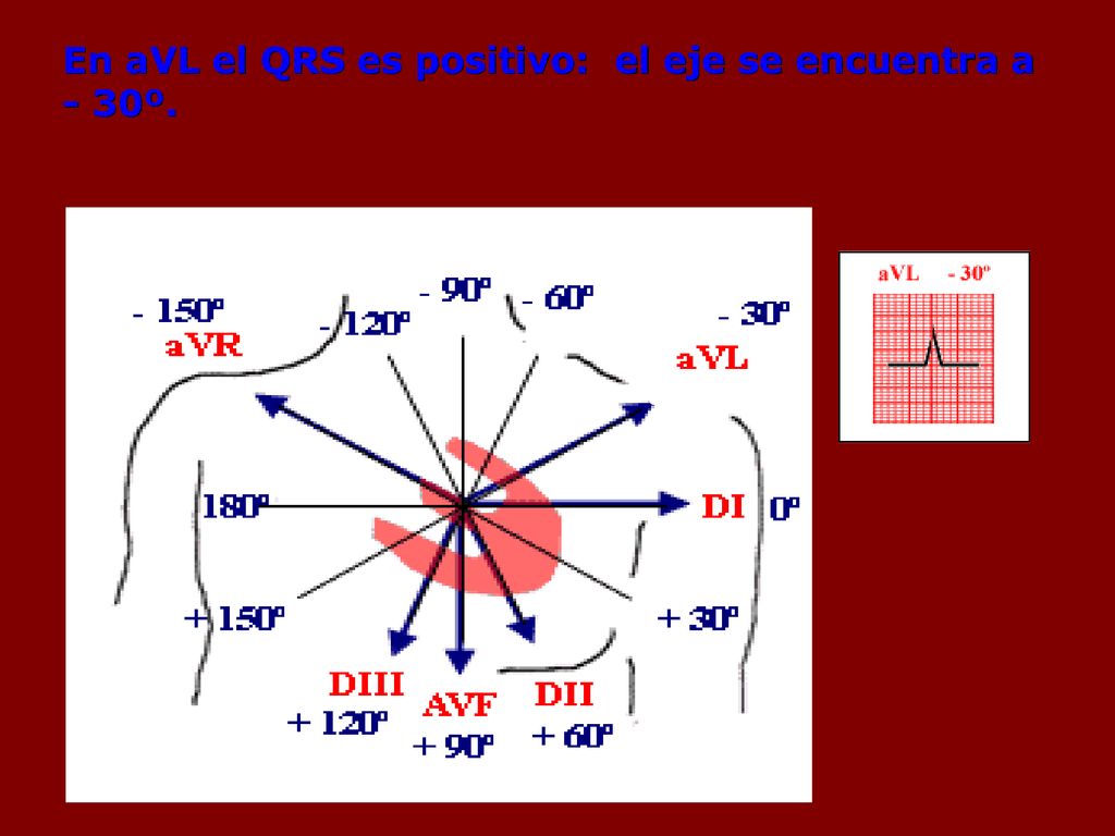 En aVL el QRS es positivo: el eje se encuentra a - 30º.