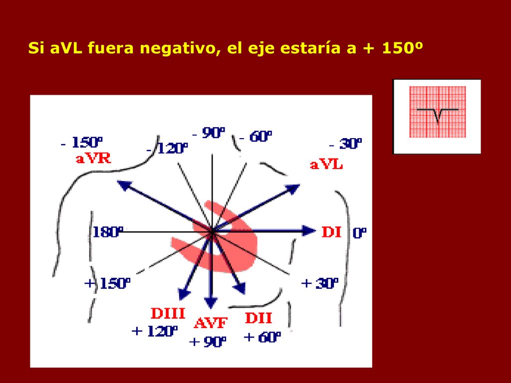 Si aVL fuera negativo, el eje estaría a + 150º