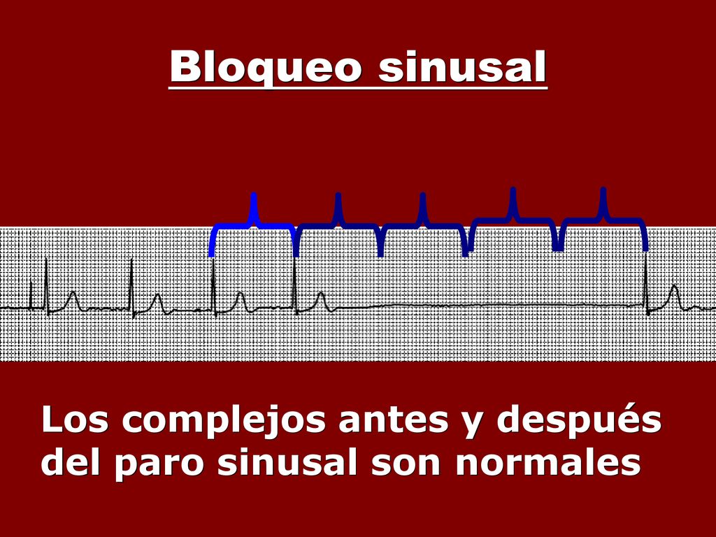 Bloqueo sinusal Los complejos antes y después del paro sinusal son normales