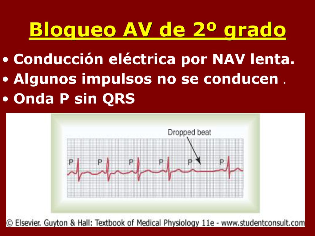 Bloqueo AV de 2º grado Conducción eléctrica por NAV lenta.