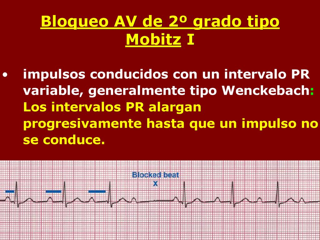 Bloqueo AV de 2º grado tipo Mobitz I