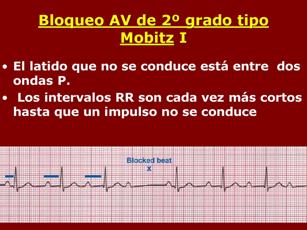 Bloqueo AV de 2º grado tipo Mobitz I