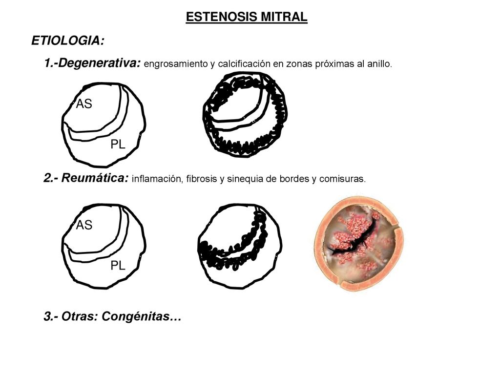 ESTENOSIS MITRAL ETIOLOGIA: 1.-Degenerativa: engrosamiento y calcificación en zonas próximas al anillo.