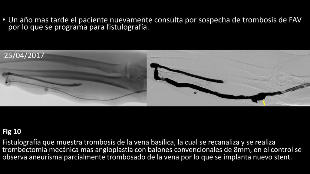 Un año mas tarde el paciente nuevamente consulta por sospecha de trombosis de FAV por lo que se programa para fistulografía.