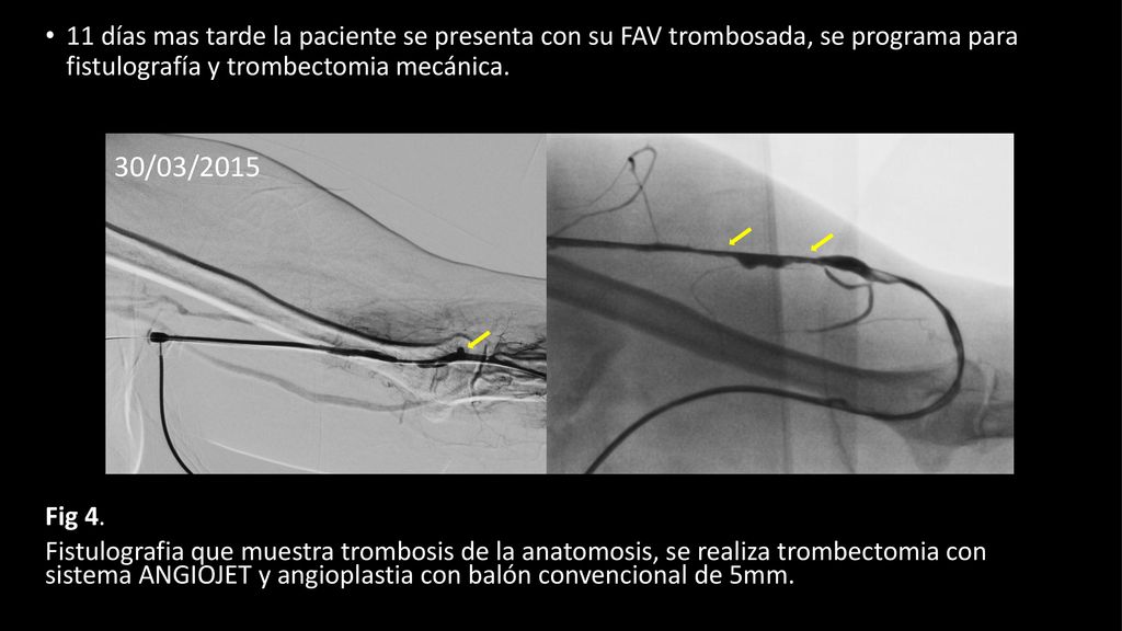 11 días mas tarde la paciente se presenta con su FAV trombosada, se programa para fistulografía y trombectomia mecánica.