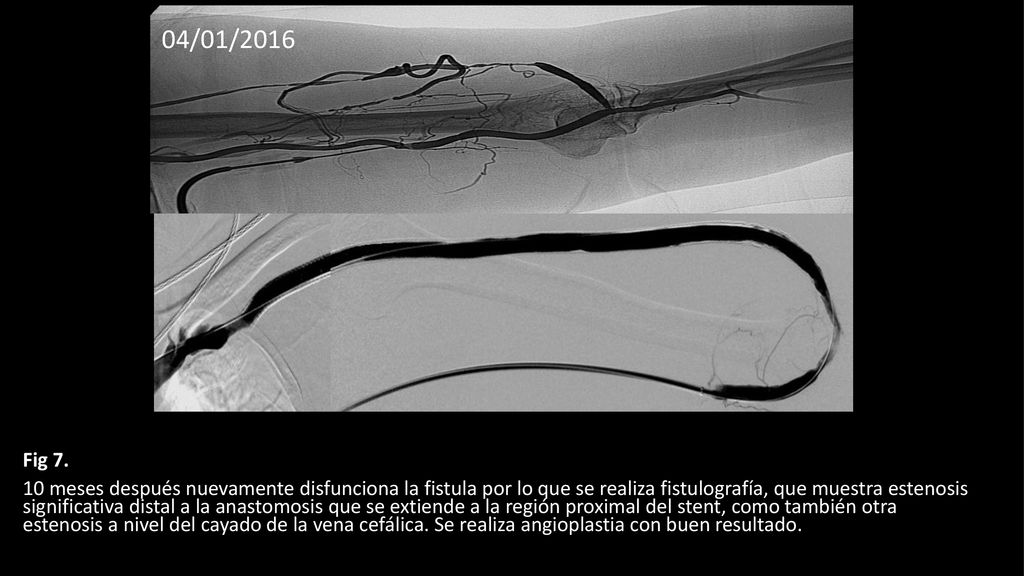 04/01/2016 Fig 7. (04/01/2016) 10 meses mas tarde la fistula nuevamente disfunciona por lo que se realiza nueva fistulografía.