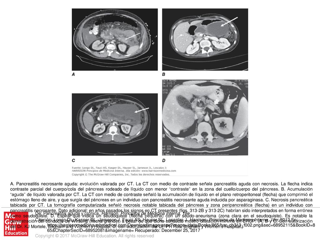 A. Pancreatitis necrosante aguda: evolución valorada por CT