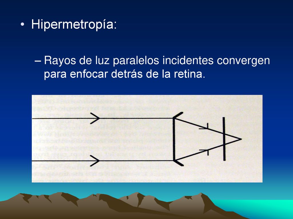 Hipermetropía: Rayos de luz paralelos incidentes convergen para enfocar detrás de la retina.
