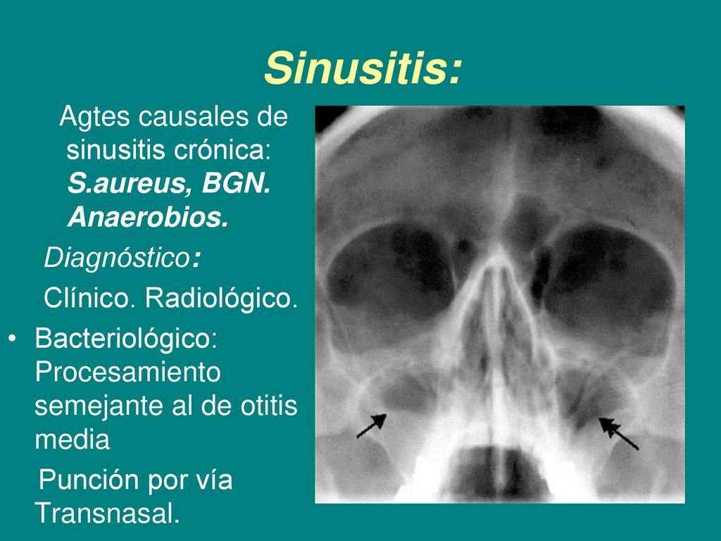 Sinusitis: Agtes causales de sinusitis crónica: S.aureus, BGN. Anaerobios. Diagnóstico: Clínico. Radiológico.