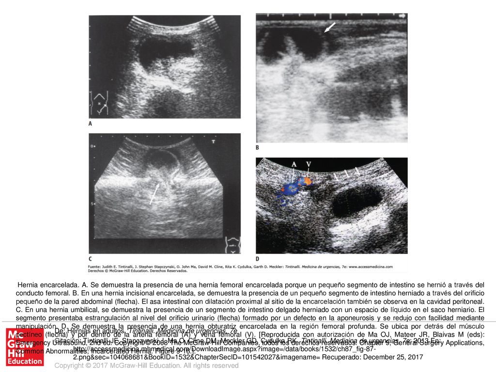 Hernia encarcelada. A. Se demuestra la presencia de una hernia femoral encarcelada porque un pequeño segmento de intestino se hernió a través del conducto femoral. B. En una hernia incisional encarcelada, se demuestra la presencia de un pequeño segmento de intestino herniado a través del orificio pequeño de la pared abdominal (flecha). El asa intestinal con dilatación proximal al sitio de la encarcelación también se observa en la cavidad peritoneal. C. En una hernia umbilical, se demuestra la presencia de un segmento de intestino delgado herniado con un espacio de líquido en el saco herniario. El segmento presentaba estrangulación al nivel del orificio urinario (flecha) formado por un defecto en la aponeurosis y se redujo con facilidad mediante manipulación. D. Se demuestra la presencia de una hernia obturatriz encarcelada en la región femoral profunda. Se ubica por detrás del músculo pectíneo (flecha) y por dentro de la arteria femoral (A) y vena femoral (V). [Reproducida con autorización de Ma OJ, Mateer JR, Blaivas M (eds): Emergency Ultrasound, 2nd ed. Copyright © 2008 The McGraw-Hill Companies, todos los derechos reservados. Chapter 9, General Surgery Applications, Common Abnormalities, Incarcerated Hernia. Figure 9-16.].