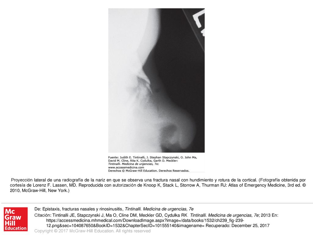 Proyección lateral de una radiografía de la nariz en que se observa una fractura nasal con hundimiento y rotura de la cortical. (Fotografía obtenida por cortesía de Lorenz F. Lassen, MD. Reproducida con autorización de Knoop K, Stack L, Storrow A, Thurman RJ: Atlas of Emergency Medicine, 3rd ed. © 2010, McGraw-Hill, New York.)
