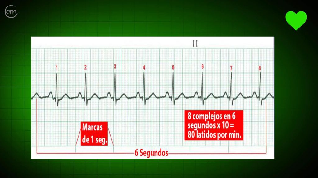 Una de las maneras más fáciles de calcular la frecuencia cardiaca de un trazo de ECG es en primer lugar calcular 6 segundos del trazo de ritmo (lo que equivale a 30 cuadros grandes en el papel del ECG). Luego cuenta el número de complejos QRS que caen dentro de estos 30 cuadros.