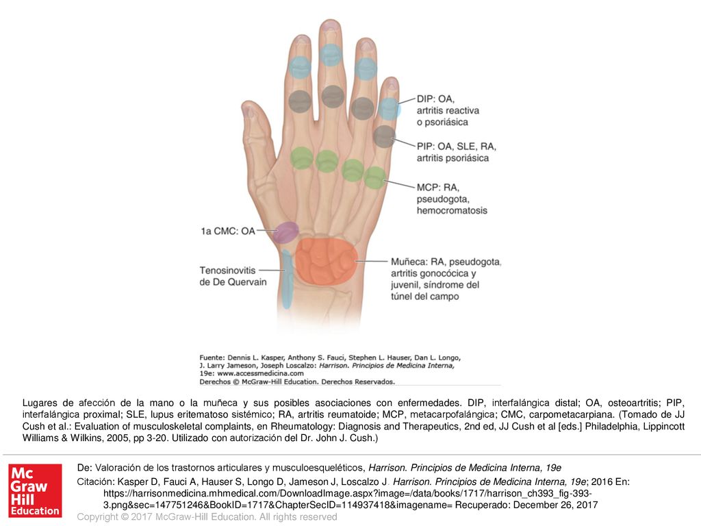 Lugares de afección de la mano o la muñeca y sus posibles asociaciones con enfermedades. DIP, interfalángica distal; OA, osteoartritis; PIP, interfalángica proximal; SLE, lupus eritematoso sistémico; RA, artritis reumatoide; MCP, metacarpofalángica; CMC, carpometacarpiana. (Tomado de JJ Cush et al.: Evaluation of musculoskeletal complaints, en Rheumatology: Diagnosis and Therapeutics, 2nd ed, JJ Cush et al [eds.] Philadelphia, Lippincott Williams & Wilkins, 2005, pp Utilizado con autorización del Dr. John J. Cush.)