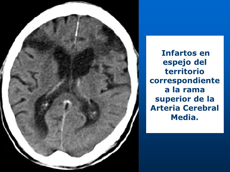 Infartos en espejo del territorio correspondiente a la rama superior de la Arteria Cerebral Media.