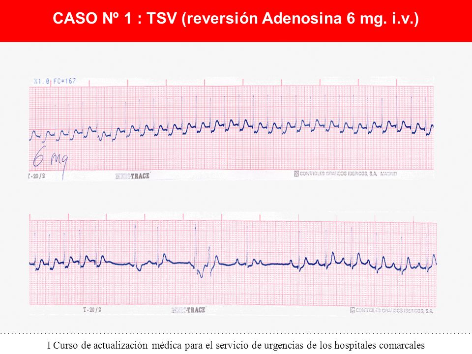 CASO Nº 1 : TSV (reversión Adenosina 6 mg. i.v.)