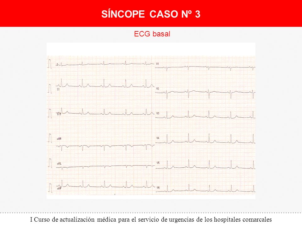 SÍNCOPE CASO Nº 3 ECG basal