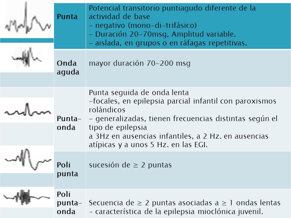 Punta Potencial transitorio puntiagudo diferente de la actividad de base. - negativo (mono-di-trifásico)