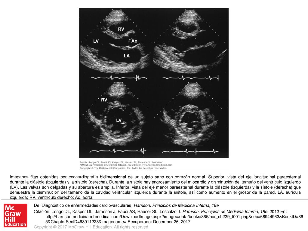 Imágenes fijas obtenidas por ecocardiografía bidimensional de un sujeto sano con corazón normal. Superior: vista del eje longitudinal paraesternal durante la diástole (izquierda) y la sístole (derecha). Durante la sístole hay engrosamiento del miocardio y disminución del tamaño del ventrículo izquierdo (LV). Las valvas son delgadas y su abertura es amplia. Inferior: vista del eje menor paraesternal durante la diástole (izquierda) y la sístole (derecha) que demuestra la disminución del tamaño de la cavidad ventricular izquierda durante la sístole, así como aumento en el grosor de la pared. LA, aurícula izquierda; RV, ventrículo derecho; Ao, aorta.
