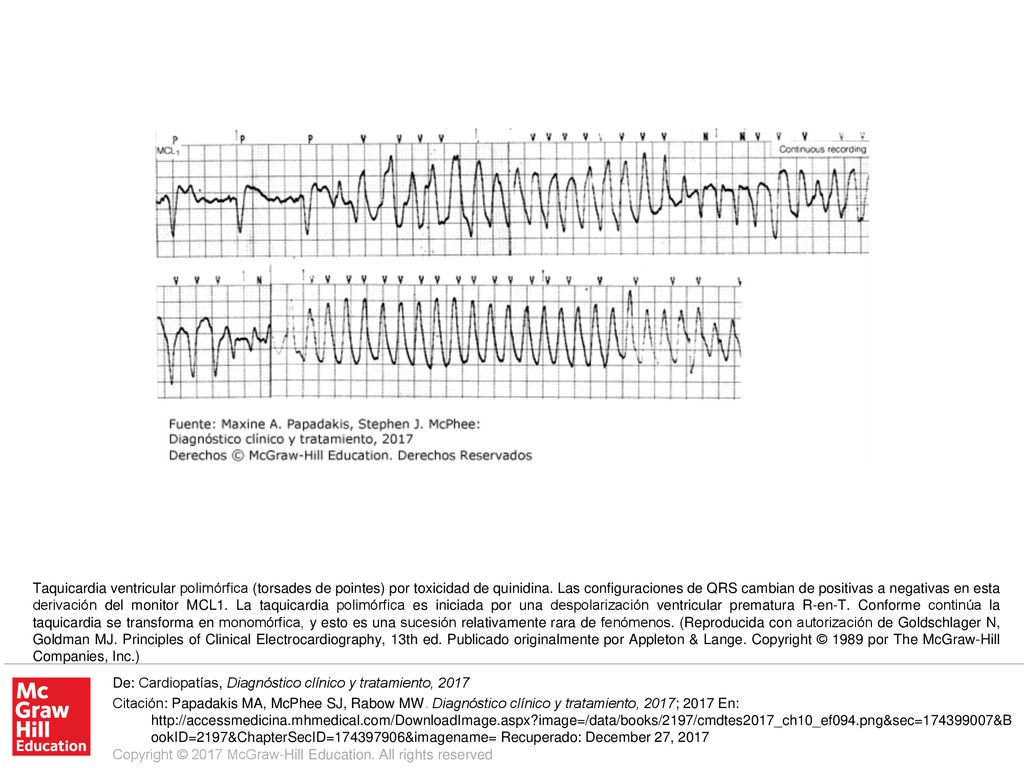Taquicardia ventricular polimórfica (torsades de pointes) por toxicidad de quinidina. Las configuraciones de QRS cambian de positivas a negativas en esta derivación del monitor MCL1. La taquicardia polimórfica es iniciada por una despolarización ventricular prematura R-en-T. Conforme continúa la taquicardia se transforma en monomórfica, y esto es una sucesión relativamente rara de fenómenos. (Reproducida con autorización de Goldschlager N, Goldman MJ. Principles of Clinical Electrocardiography, 13th ed. Publicado originalmente por Appleton & Lange. Copyright © 1989 por The McGraw-Hill Companies, Inc.)