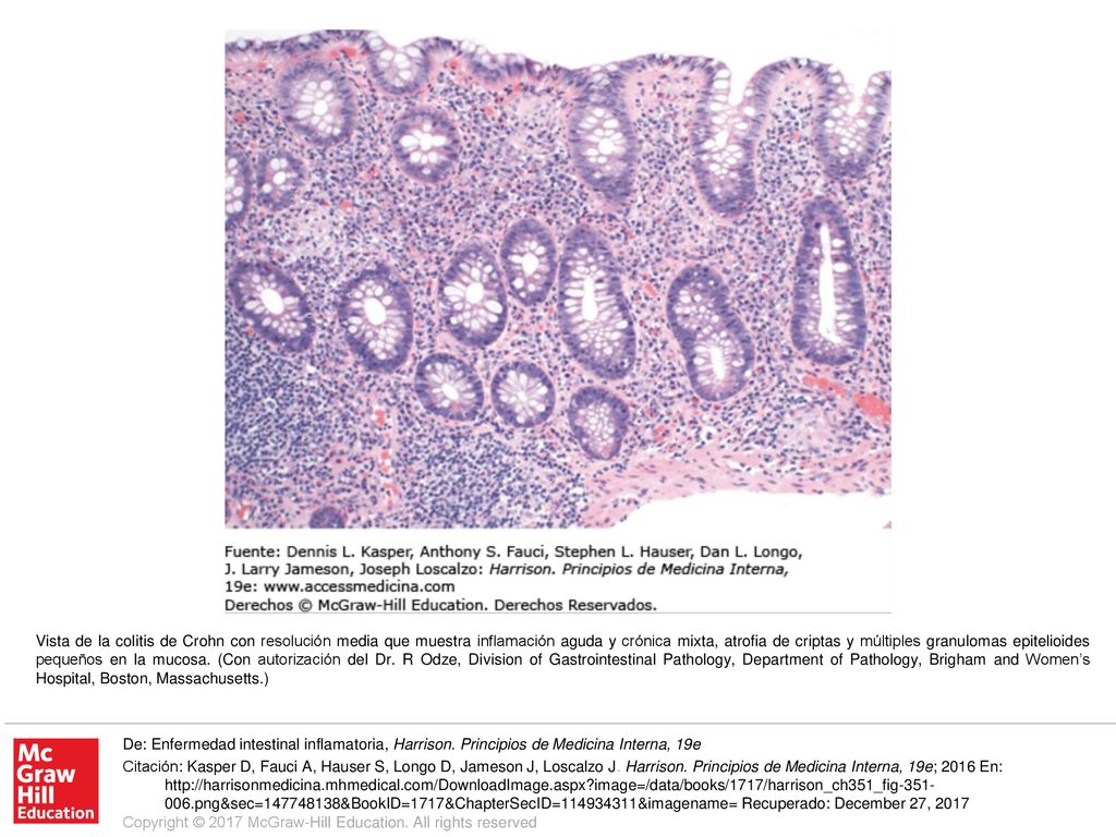 Vista de la colitis de Crohn con resolución media que muestra inflamación aguda y crónica mixta, atrofia de criptas y múltiples granulomas epitelioides pequeños en la mucosa. (Con autorización del Dr. R Odze, Division of Gastrointestinal Pathology, Department of Pathology, Brigham and Women’s Hospital, Boston, Massachusetts.)