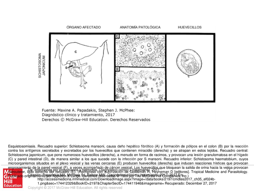 Esquistosomiasis. Recuadro superior: Schistosoma mansoni, causa daño hepático fibrótico (A) y formación de pólipos en el colon (B) por la reacción contra los antígenos secretados y excretados por los huevecillos que contienen miracidio (derecha) y se atrapan en estos tejidos. Recuadro central: Schistosoma japonicum, que pone numerosos huevecillos (derecha), a menudo en forma de racimos, y provocan una lesión granulomatosa en el hígado (C) y pared intestinal (D), de manera similar a los que sucede con la infección por S mansoni. Recuadro inferior: Schistosoma haematobium, cuyos microorganismos situados en el plexo vesical y las venas cercanas (E) producen huevecillos (derecha) que inducen reacciones hísticas que provocan engrosamiento de la pared vesical (F), a veces acompañado de cáncer vesical. Los huevecillos que bloquean la salida de orina hacia la vejiga provocan hidrouteter, lado derecho del recuadro (E). (Reimpreso con autorización de Goldsmith R, Heyneman D [editores]. Tropical Medicine and Parasitology. Publicado originalmente por Appleton & Lange. Derechos reservados © 1989 por The McGraw-Hill Companies, Inc.)