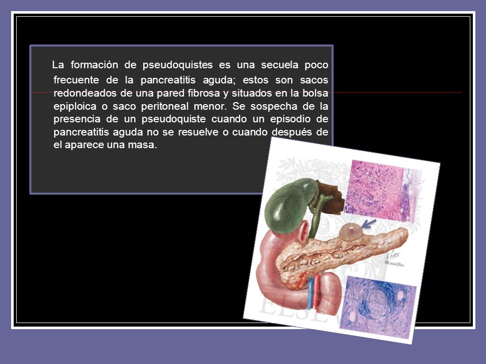 La formación de pseudoquistes es una secuela poco frecuente de la pancreatitis aguda; estos son sacos redondeados de una pared fibrosa y situados en la bolsa epiploica o saco peritoneal menor.