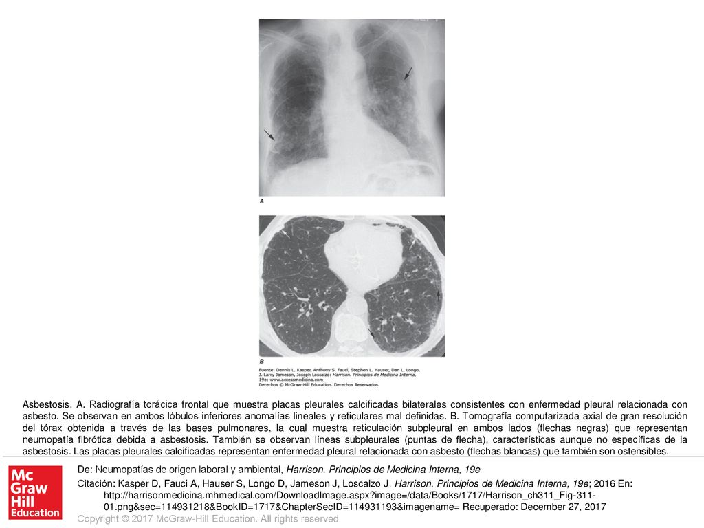 Asbestosis. A. Radiografía torácica frontal que muestra placas pleurales calcificadas bilaterales consistentes con enfermedad pleural relacionada con asbesto. Se observan en ambos lóbulos inferiores anomalías lineales y reticulares mal definidas. B. Tomografía computarizada axial de gran resolución del tórax obtenida a través de las bases pulmonares, la cual muestra reticulación subpleural en ambos lados (flechas negras) que representan neumopatía fibrótica debida a asbestosis. También se observan líneas subpleurales (puntas de flecha), características aunque no específicas de la asbestosis. Las placas pleurales calcificadas representan enfermedad pleural relacionada con asbesto (flechas blancas) que también son ostensibles.