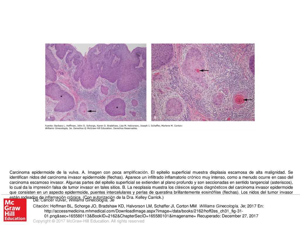 Carcinoma epidermoide de la vulva. A. Imagen con poca amplificación