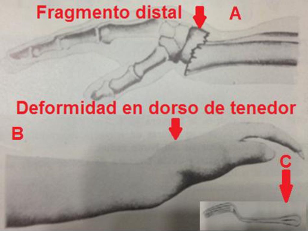 En esta diapositiva te ilustramos con un esquema el desplazamiento del fragmento distal del radio en la articulación radiocarpiana, cuando esta fractura ocurre por mecanismo indirecto, el cual es la caída con la muñeca en extensión, fíjese en su libro de texto que existen otras fracturas del extremo distal del radio, pero para que sea fractura de Colles, ocurre por mecanismo indirecto, hasta 3 centímetros de la línea articular radiocarpiana y con el desplazamiento característico del fragmento distal