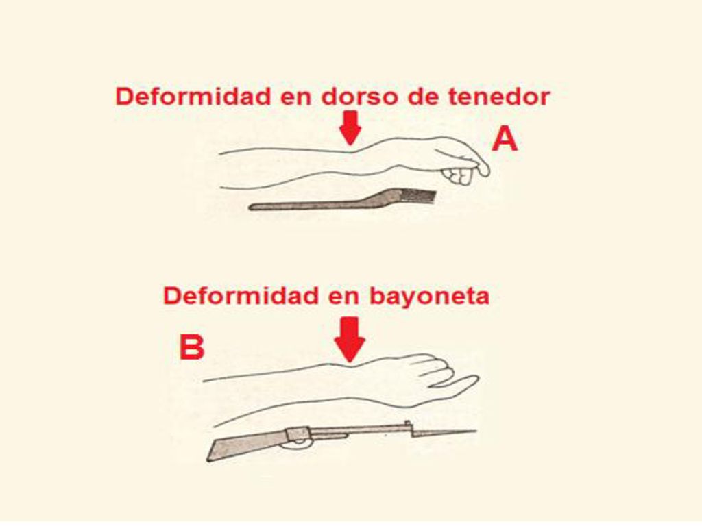 En la presente diapositiva les mostramos dos figuras, en la figura A, le volvemos a mostrar la deformidad en dorso de tenedor, y en la figura B la deformidad en bayoneta esta otra deformidad usted se percata que se ve con la mano vista desde ventral o dorsal y la deformidad la condiciona el desplazamiento lateral o radial del fragmento distal