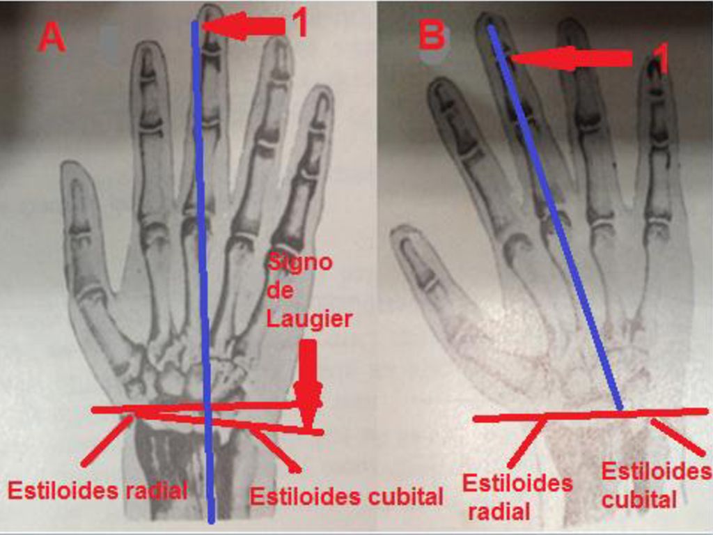 En la figura A usted puede apreciar con el número 1, en color azul la línea de descarga del miembro superior que pasa por el tercer dedo, verá también en colores rojo unas líneas que señalizan los estiloides radial y cubital y una línea oblicua que pasa tangencial a ambos estiloides, esta línea oblicua ocurre por la particularidad anatómica que el estiloides radial es 1,5 centímetros más largo que el estiloides cubital, pero en la figura B usted verá como se desvía la línea de descarga cuando ocurre la fractura y además podrá observar que la línea oblicua de torna horizontal