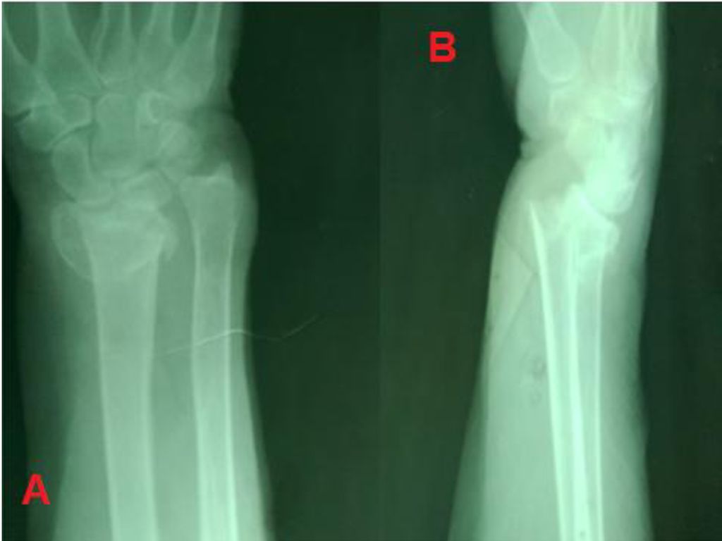 En esta diapositiva podemos observar dos vistas de una muñeca fracturada, en la A es la vista anteroposterior donde se observa que los estiloides radial y cubital están al mismo nivel y en la vista B está ilustrada una radiografía en vista lateral donde puede apreciar el desplazamiento característico del fragmento distal