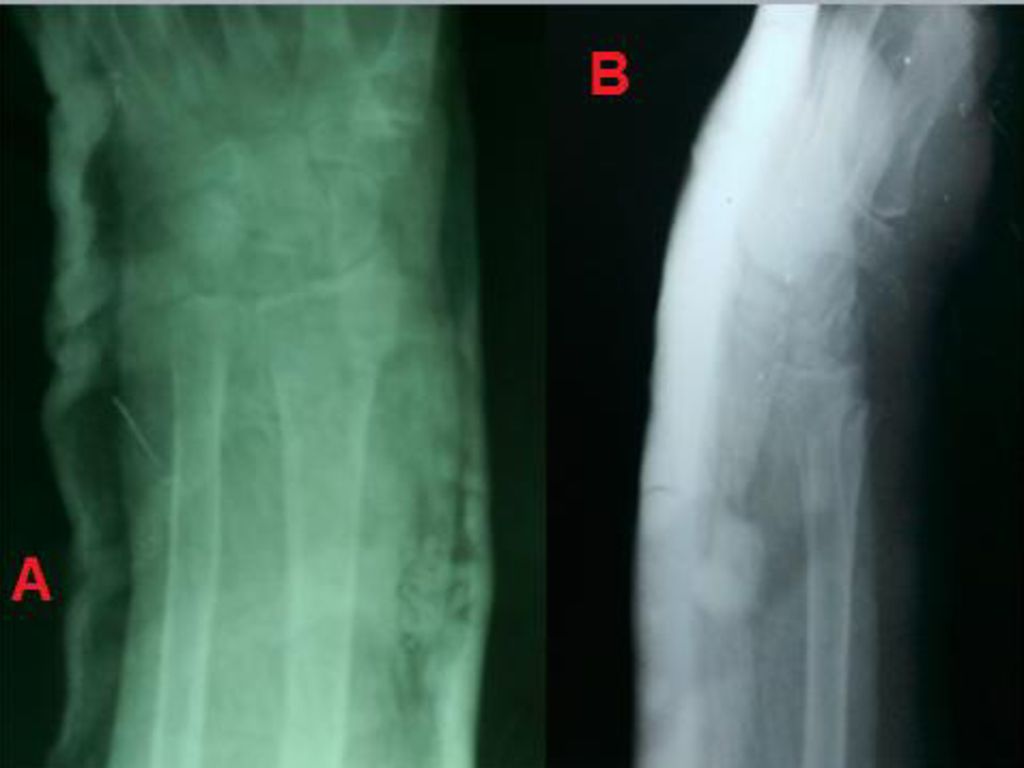 Usted puede apreciar en la vista A una radiografía anteroposterior y en la B una radiografía lateral, ambas después de reducida la fractura y como puede observar con la escayola de yeso que permite su inmovilización