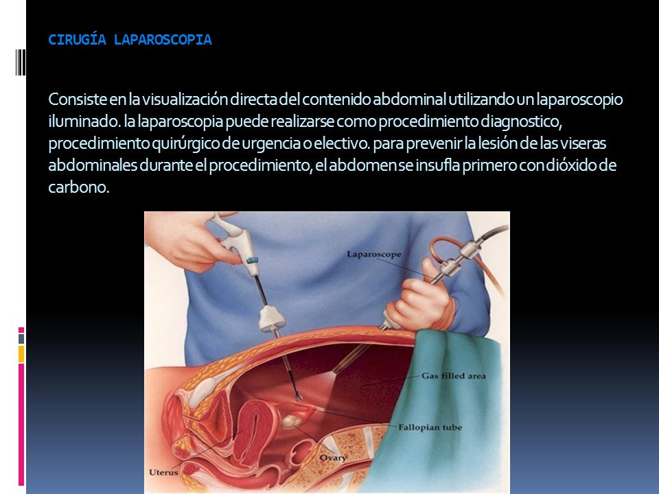 cirugía laparoscopia Consiste en la visualización directa del contenido abdominal utilizando un laparoscopio iluminado.