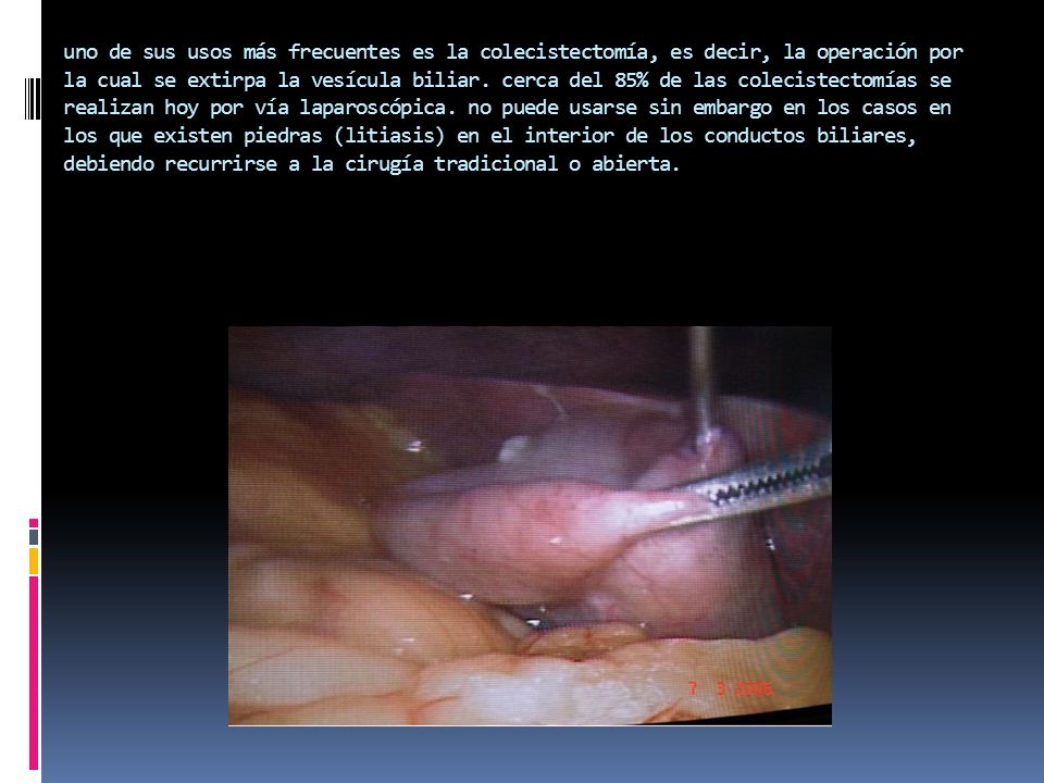 uno de sus usos más frecuentes es la colecistectomía, es decir, la operación por la cual se extirpa la vesícula biliar.