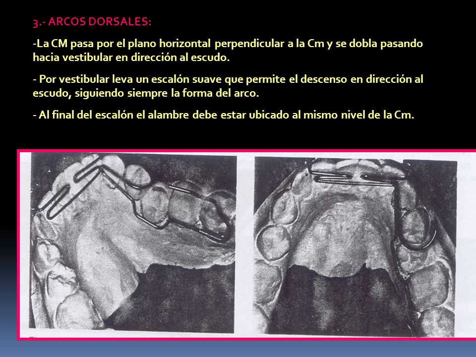 3.- ARCOS DORSALES: La CM pasa por el plano horizontal perpendicular a la Cm y se dobla pasando hacia vestibular en dirección al escudo.