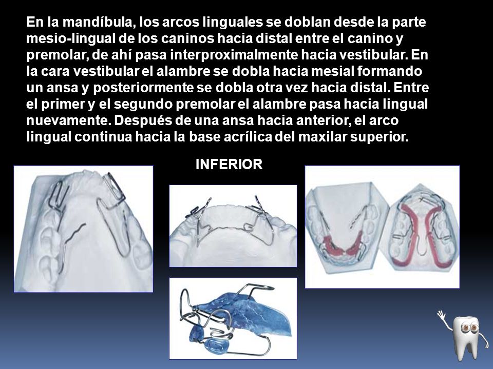 En la mandíbula, los arcos linguales se doblan desde la parte mesio-lingual de los caninos hacia distal entre el canino y premolar, de ahí pasa interproximalmente hacia vestibular. En la cara vestibular el alambre se dobla hacia mesial formando un ansa y posteriormente se dobla otra vez hacia distal. Entre el primer y el segundo premolar el alambre pasa hacia lingual nuevamente. Después de una ansa hacia anterior, el arco lingual continua hacia la base acrílica del maxilar superior.