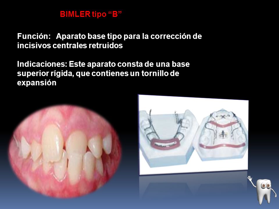 BIMLER tipo B Función: Aparato base tipo para la corrección de incisivos centrales retruidos.