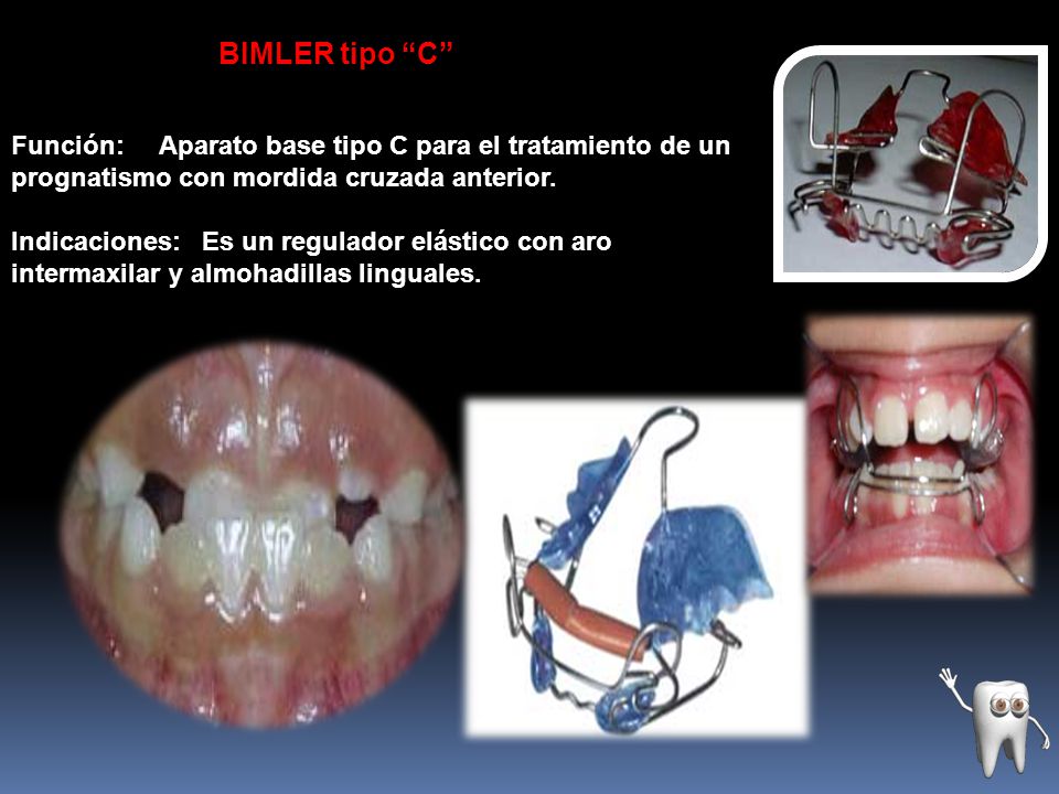 BIMLER tipo C Función: Aparato base tipo C para el tratamiento de un prognatismo con mordida cruzada anterior.