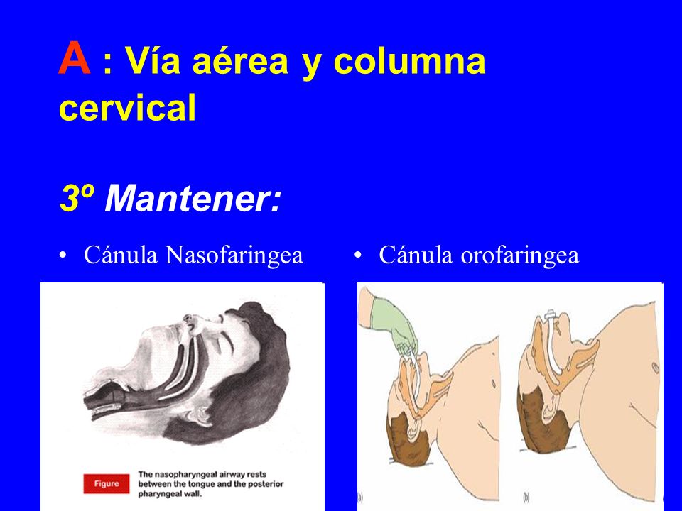 A : Vía aérea y columna cervical 3º Mantener:
