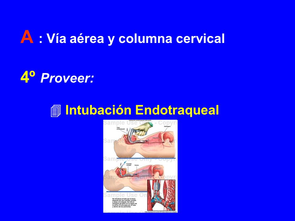 A : Vía aérea y columna cervical 4º Proveer:  Intubación Endotraqueal