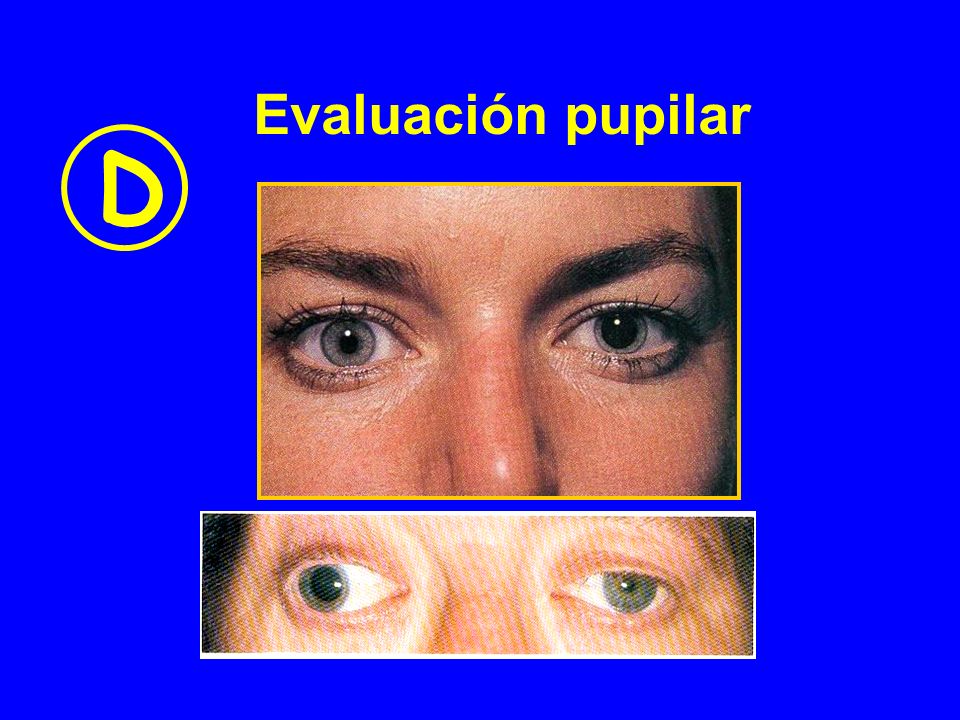 Evaluación pupilar D