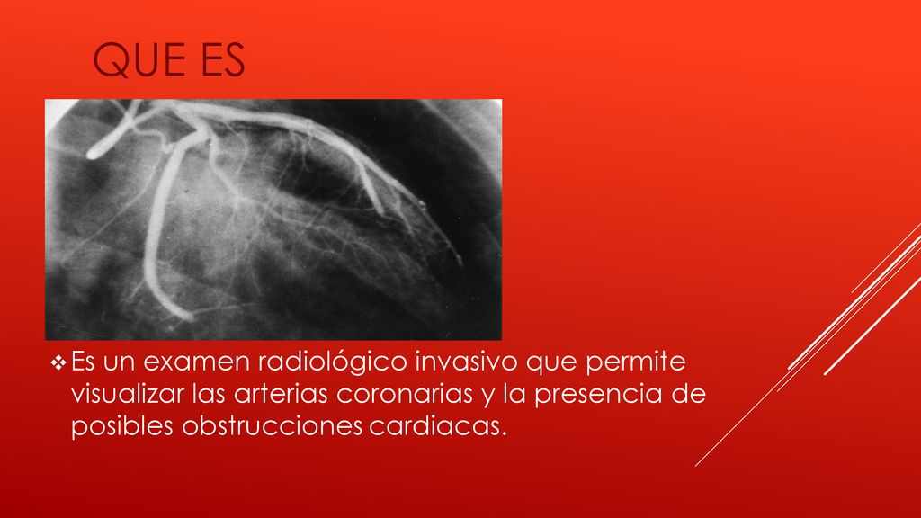 QUE ES Es un examen radiológico invasivo que permite visualizar las arterias coronarias y la presencia de posibles obstrucciones cardiacas.