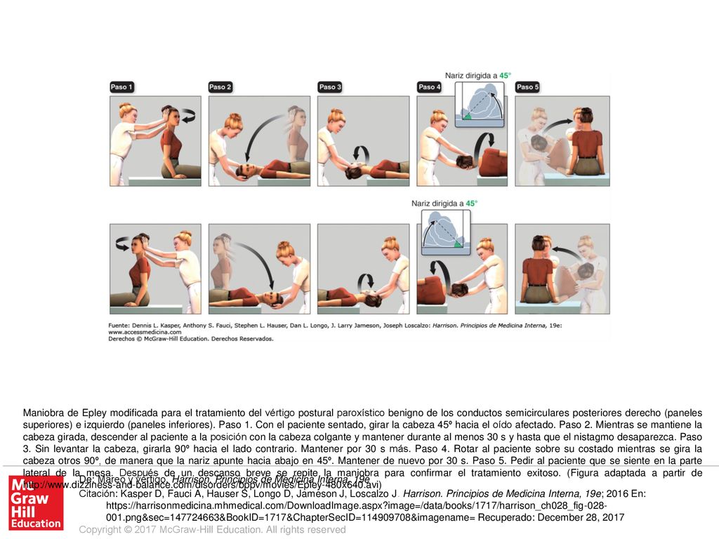 Maniobra de Epley modificada para el tratamiento del vértigo postural paroxístico benigno de los conductos semicirculares posteriores derecho (paneles superiores) e izquierdo (paneles inferiores). Paso 1. Con el paciente sentado, girar la cabeza 45º hacia el oído afectado. Paso 2. Mientras se mantiene la cabeza girada, descender al paciente a la posición con la cabeza colgante y mantener durante al menos 30 s y hasta que el nistagmo desaparezca. Paso 3. Sin levantar la cabeza, girarla 90º hacia el lado contrario. Mantener por 30 s más. Paso 4. Rotar al paciente sobre su costado mientras se gira la cabeza otros 90º, de manera que la nariz apunte hacia abajo en 45º. Mantener de nuevo por 30 s. Paso 5. Pedir al paciente que se siente en la parte lateral de la mesa. Después de un descanso breve se repite la maniobra para confirmar el tratamiento exitoso. (Figura adaptada a partir de